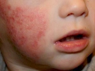 eczema