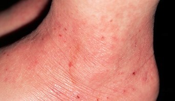 eczema