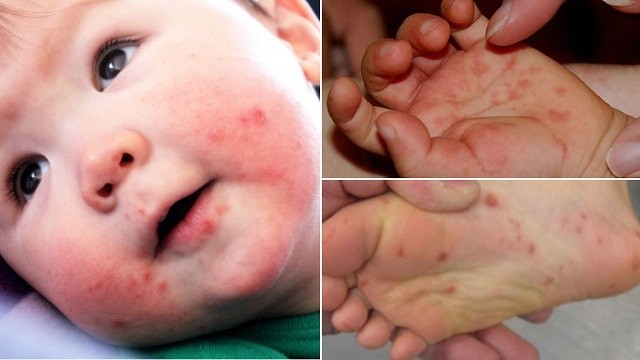 Mão-pé-boca: doença causa lesões vermelhas na pele das crianças
